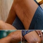10 Important Side Effects of Metoprolol That You Need to Know